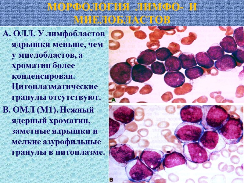 МОРФОЛОГИЯ  ЛИМФО-  И МИЕЛОБЛАСТОВ А. ОЛЛ. У лимфобластов ядрышки меньше, чем у